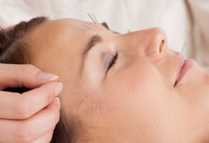 acupuncture for migraine