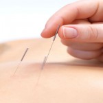 acupuncture treatment