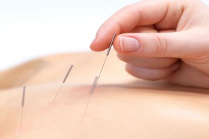 acupuncture treatment
