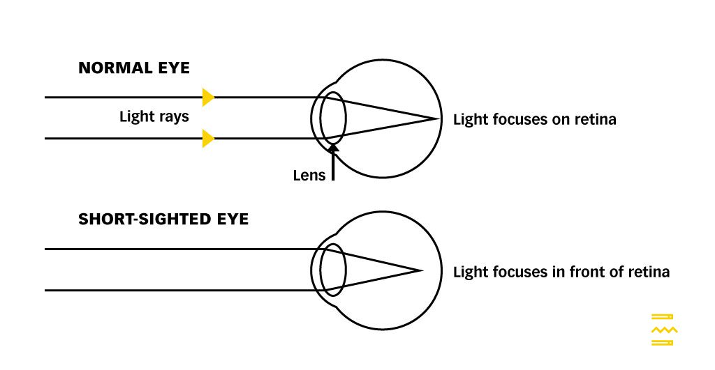 Normal vs Myopic Eye PULSE TCM CLINIC