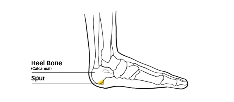 Heel-Spur