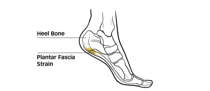 Plantar-Fascia