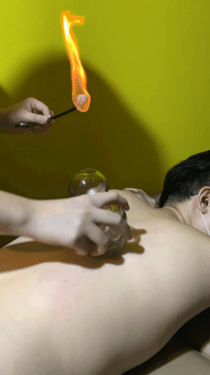 Cupping_How_it_enhances_recovery_and_sports_performance_3