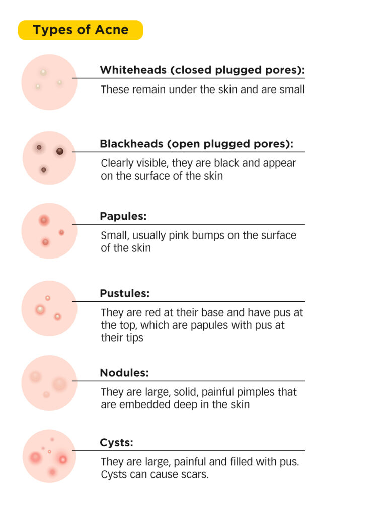 TCM perspective How certain foods can cause acne 2