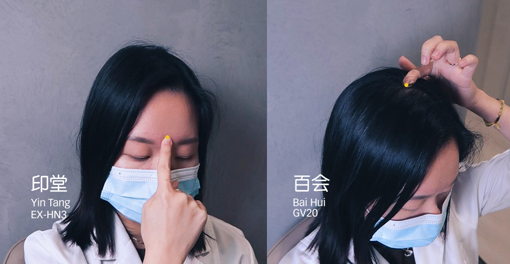 insomnia, tcm, acupuncture, acupoint