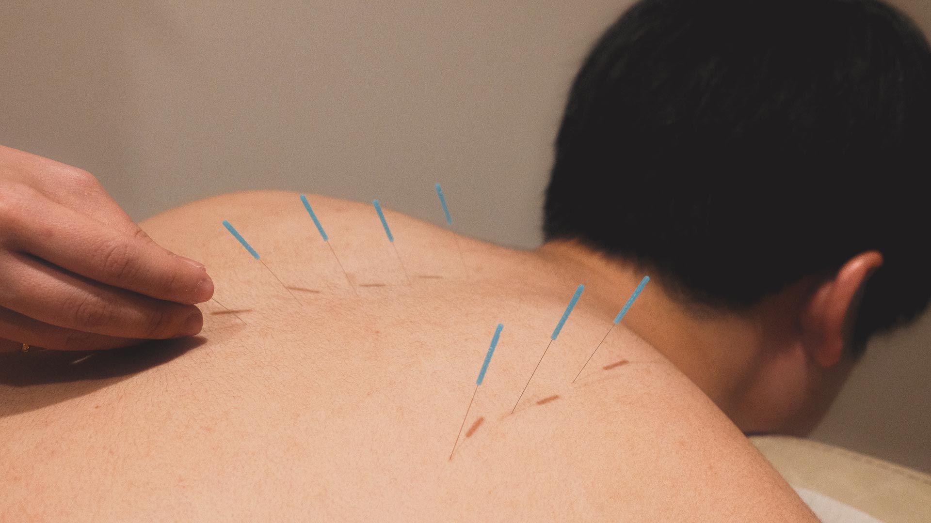 Acupuncture needles in man's back