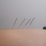 acupuncture needles on a patient