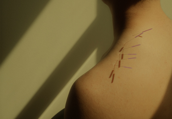 Person receiving acupuncture treatment