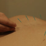 acupuncture
