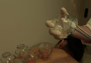 cupping therapy