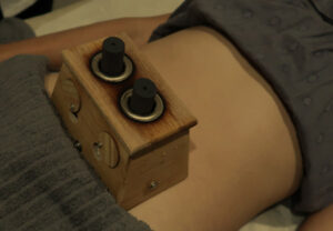 moxibustion therapy